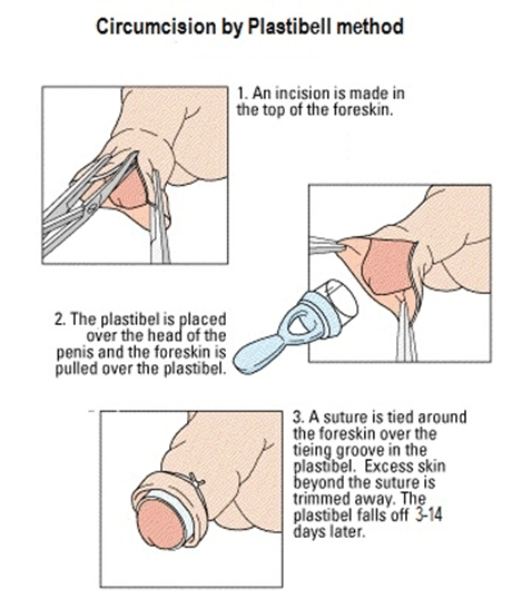 Circumcision-Clinic-Cardiff-Plastibell-method